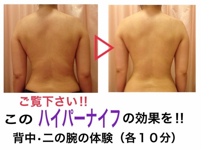 ハイパー前・後 ハイパー前・後
